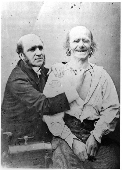 前頭筋のファラデー化、「Mechanisme de la physiognomie humaine ou analyze electrophysiologique des passions」、Duchenne de Boulogne、1876年、パリ発行 作： Guillaume Benjamin Armand Duchenne de Boulogne